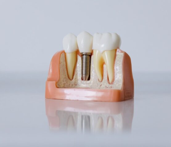 En tandmodell som visar ett tandimplantat mellan två naturliga tänder på en reflekterande yta, som ger insikt i tandreglerande eskilstuna-procedurer tillgängliga genom privata tandläkare Eskilstuna.
