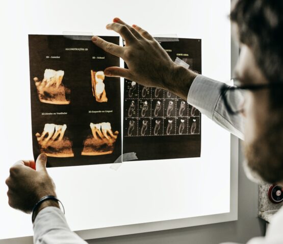 En person undersöker tandröntgenbilder på en ljuslåda, med fokus på detaljerade närbilder av tänder och käkstrukturer. I Eskilstuna görs en sådan noggrann analys ofta av privata tandläkare specialiserade på tandreglering. Röntgenbilderna hålls på plats med tejp.